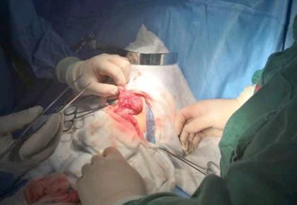 20個月的寶寶吞8個磁力珠 造成胃腸穿孔……　